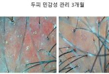 두피민감성 3개월 관리후기