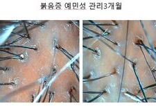 붉음증 예민성두피 3개월관리후기
