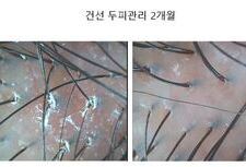 건선두피관리 2개월 관리후기
