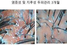염증성 및 지루성 두피 3개월관리후기