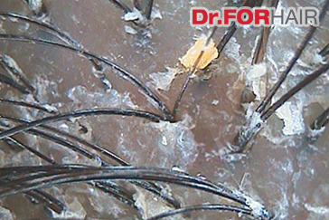 지루성두피모발밀도